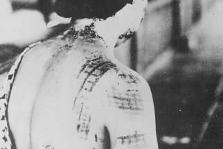 A Japanese woman suffers burns from thermal radiation after the United States dropped nuclear bombs on Japan in World War II. 