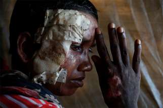 A Rohingya woman who says she was beaten and burned by soldiers in Myanmar poses for a photograph in late October at a refugee camp in Cox&#039;s Bazar, Bangladesh.